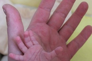新生儿窒息后的护理新生儿窒息的原因有哪些